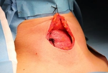 Tiroid Nodül Ameliyatı Sonrası