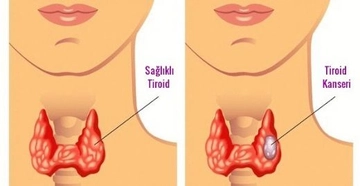Tiroid Kanseri Belirtileri ve Tedavisi