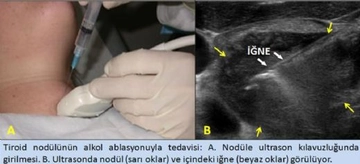 Tiroid Kistik Nodül Tedavi