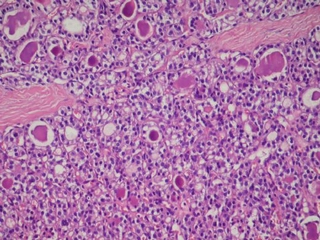 Tiroid Papiller Ca Hastalığın Belirtisi